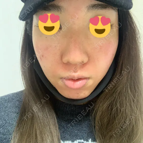 ピーリング（ニキビ・毛穴） / ダーマペン TRUE DESIGN CLINIC DAY 0 メイン用