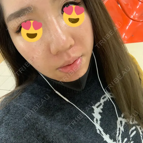 ピーリング（ニキビ・毛穴） / ダーマペン TRUE DESIGN CLINIC DAY 2 メイン用