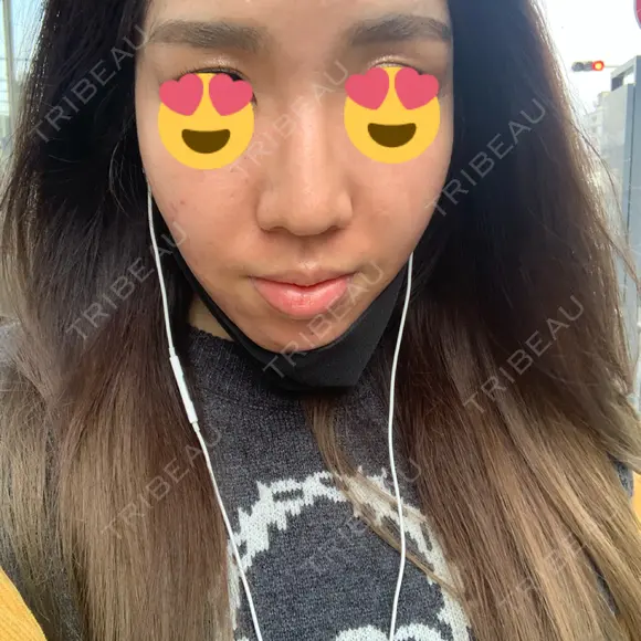 ピーリング（ニキビ・毛穴） / ダーマペン TRUE DESIGN CLINIC AFTER メイン用