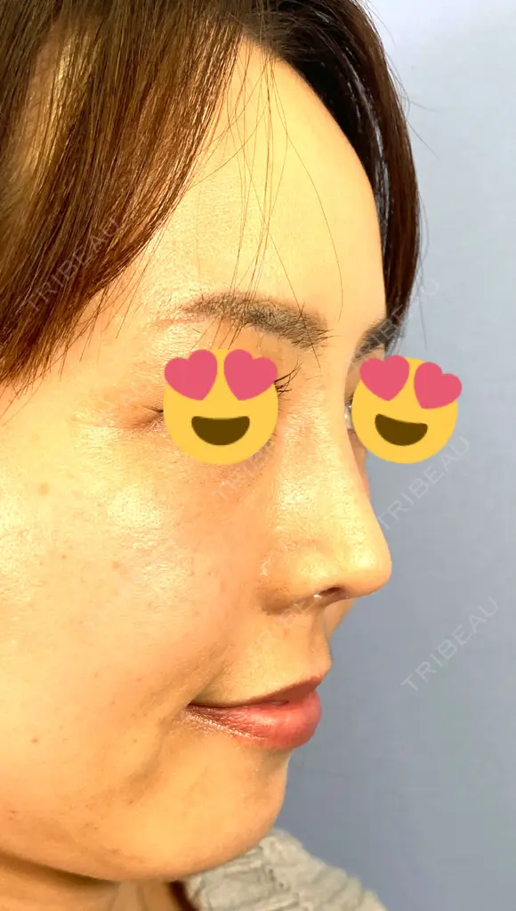 鼻尖形成（切開） / 鼻中隔延長（切開） / 軟骨移植 / ワシ鼻修正・ハンプ切除 / 真皮移植 湘南美容クリニック 上野院 DAY 31 メイン用