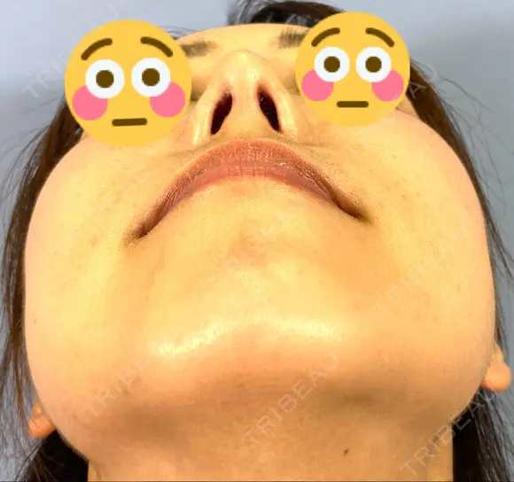 鼻尖形成（切開） / 鼻中隔延長（切開） / 軟骨移植 / ワシ鼻修正・ハンプ切除 / 真皮移植 湘南美容クリニック 上野院 DAY 31 メイン用