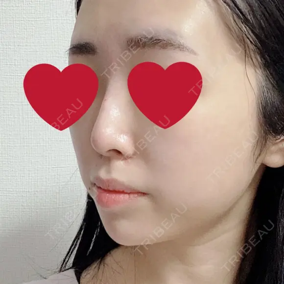 ヒアルロン酸注入（鼻） / ヒアルロン酸注入（あご） 新宿ビューティークリニック 新宿院 DAY 0 メイン用