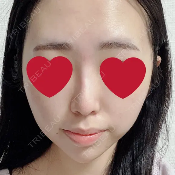 ヒアルロン酸注入（鼻） / ヒアルロン酸注入（あご） 新宿ビューティークリニック 新宿院 AFTER メイン用