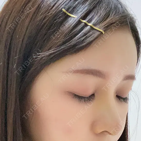 鼻尖形成（切開） / 鼻中隔延長（切開） / 軟骨移植 eクリニック 金沢本院 DAY 7 メイン用