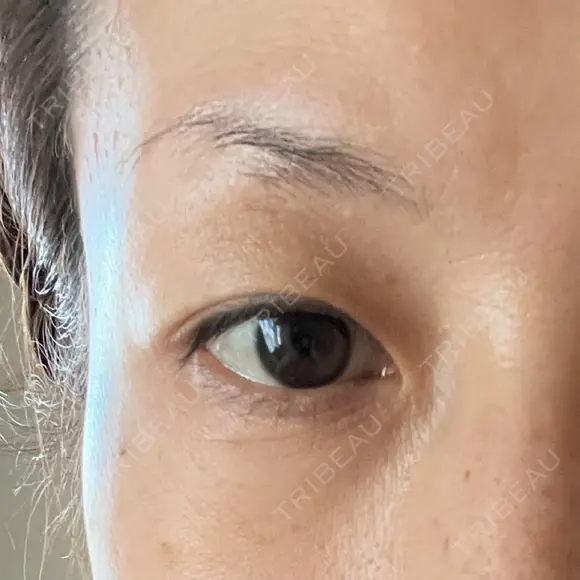 眼瞼下垂（切開） 湘南美容クリニック 秋葉原院 DAY 50 メイン用