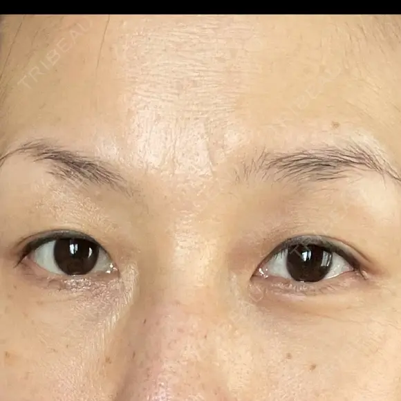 眼瞼下垂（切開） 湘南美容クリニック 秋葉原院 DAY 50 メイン用