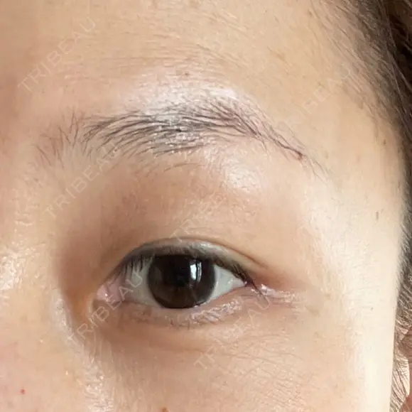 眼瞼下垂（切開） 湘南美容クリニック 秋葉原院 DAY 50 メイン用