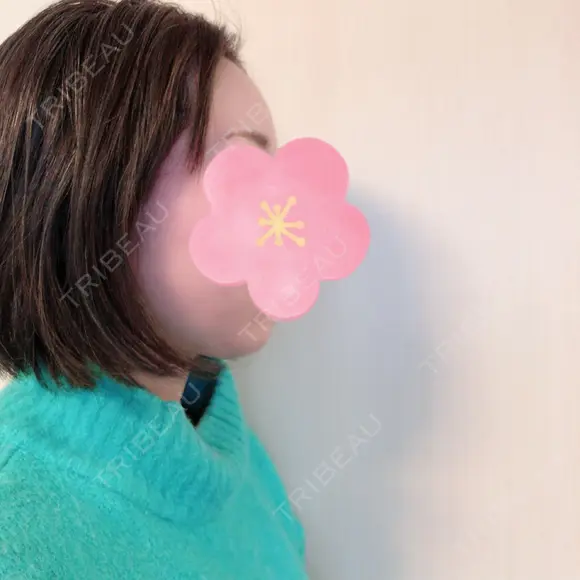 脂肪吸引（顔） 北尾クリニック DAY 27 メイン用