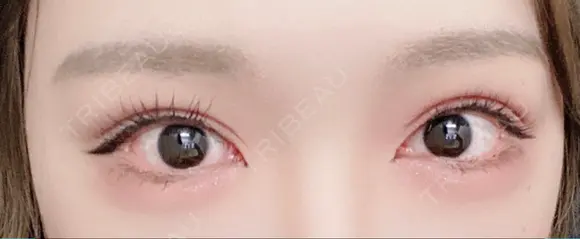 ヒアルロン酸注入（目の下） フィラークリニック 新宿院 DAY 0 メイン用