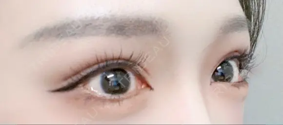 ヒアルロン酸注入（目の下） フィラークリニック 新宿院 DAY 0 メイン用