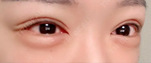 ヒアルロン酸注入（目の下） フィラークリニック 新宿院 AFTER メイン用