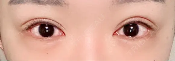 ヒアルロン酸注入（目の下） フィラークリニック 新宿院 DAY 1 メイン用