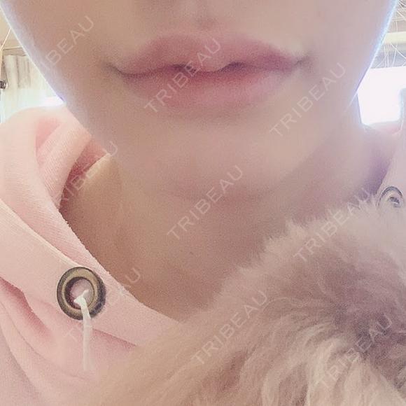 ヒアルロン酸注入（唇） / ボトックス（口角） ルラ美容クリニック 新宿院 DAY 3 メイン用