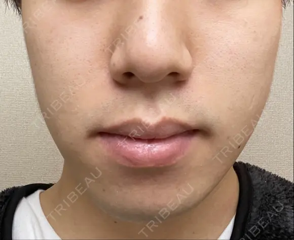 イオン導入 / 毛穴洗浄（ハイドラフェイシャルなど） Zetith Beauty Clinic 銀座院 AFTER メイン用