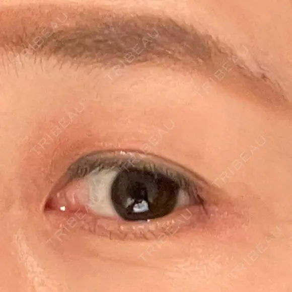 眼瞼下垂（切開） 湘南美容クリニック 秋葉原院 AFTER メイン用