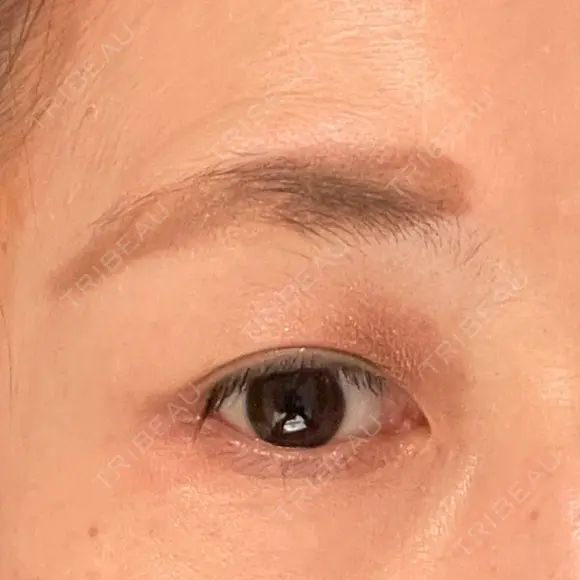 眼瞼下垂（切開） 湘南美容クリニック 秋葉原院 DAY 52 メイン用