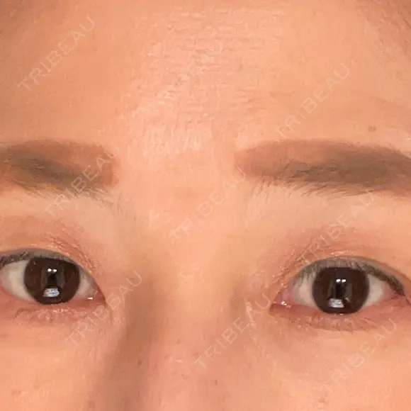 眼瞼下垂（切開） 湘南美容クリニック 秋葉原院 DAY 52 メイン用