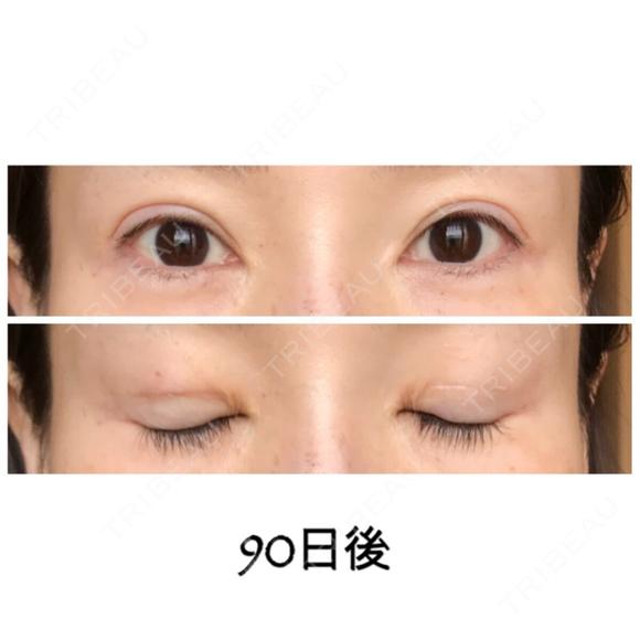 二重切開 / 目元修正 ビスポーククリニック 福岡院 DAY 90 メイン用