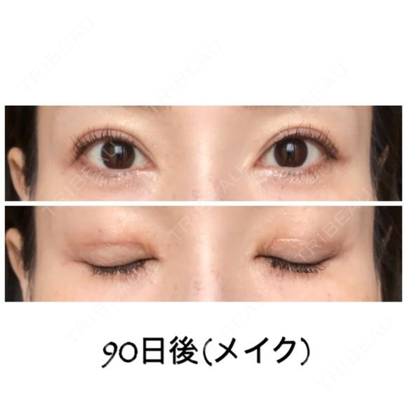 二重切開 / 目元修正 ビスポーククリニック 福岡院 DAY 90 メイン用