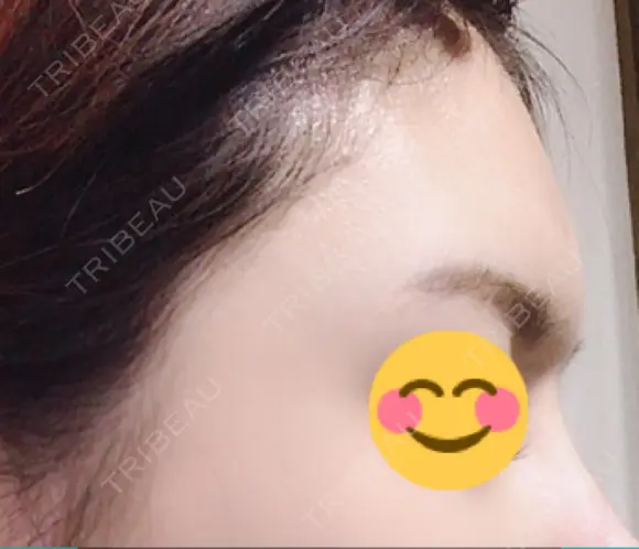 額を丸く / その他（輪郭） 品川美容外科 静岡院 DAY 68 メイン用