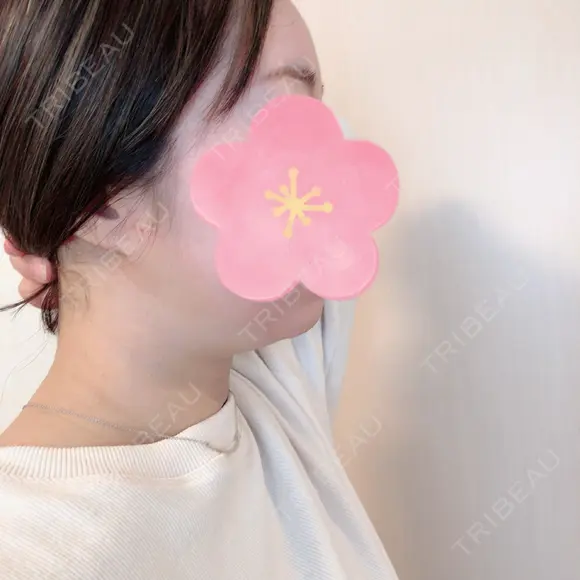 脂肪吸引（顔） 北尾クリニック DAY 31 メイン用