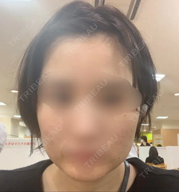ボトックス（エラ・小顔） 湘南美容クリニック 名古屋院 DAY 6 メイン用