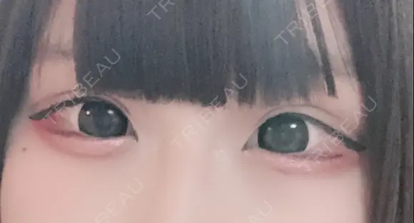 二重埋没 湘南美容クリニック 那覇院 DAY 2 メイン用