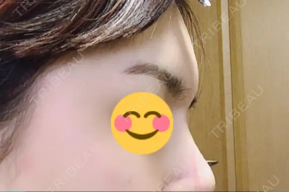 額を丸く / その他（輪郭） 品川美容外科 静岡院 DAY 71 メイン用