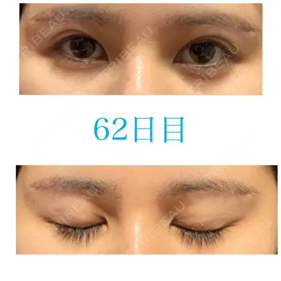 上まぶたの脂肪取り / 眉下切開 JUN CLINIC DAY 62 メイン用