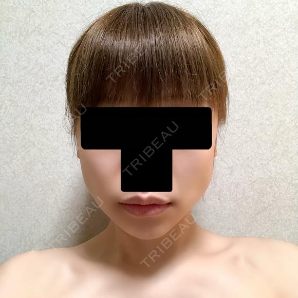バッカルファット除去 / ボトックス（エラ・小顔） 湘南美容クリニック 金山院 DAY 5 メイン用