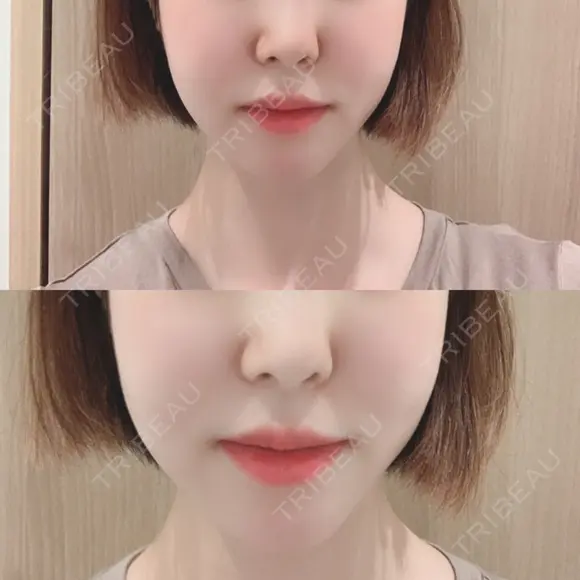 骨切り（あご） / 骨削り（エラ） / 骨削り（頬） id（アイディ）美容外科 DAY 307 メイン用
