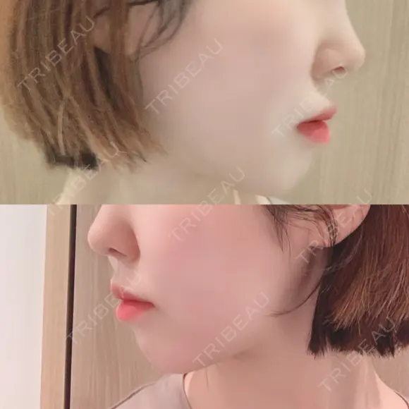 骨切り（あご） / 骨削り（エラ） / 骨削り（頬） id（アイディ）美容外科 DAY 307 メイン用