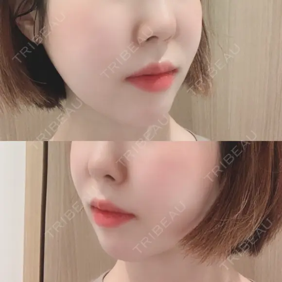 骨切り（あご） / 骨削り（エラ） / 骨削り（頬） id（アイディ）美容外科 DAY 307 メイン用