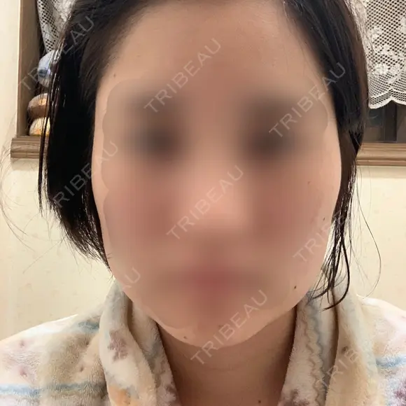 ボトックス（エラ・小顔） 湘南美容クリニック 名古屋院 DAY 8 メイン用