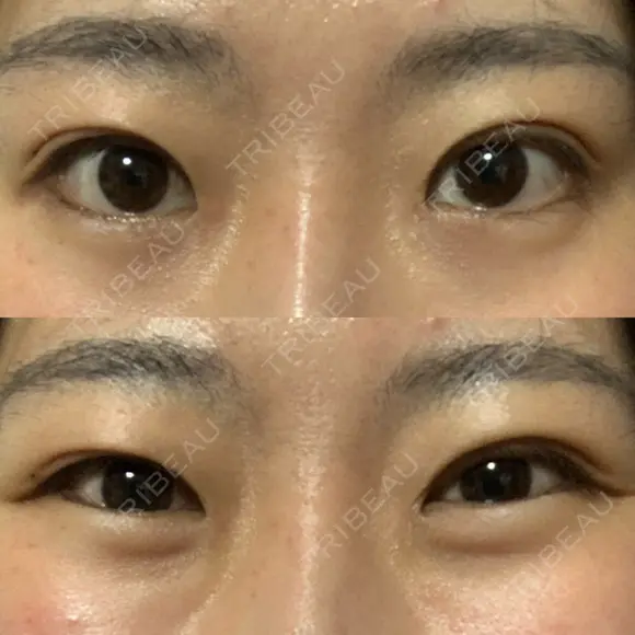 蒙古ひだ形成 R.O.clinic AFTER メイン用
