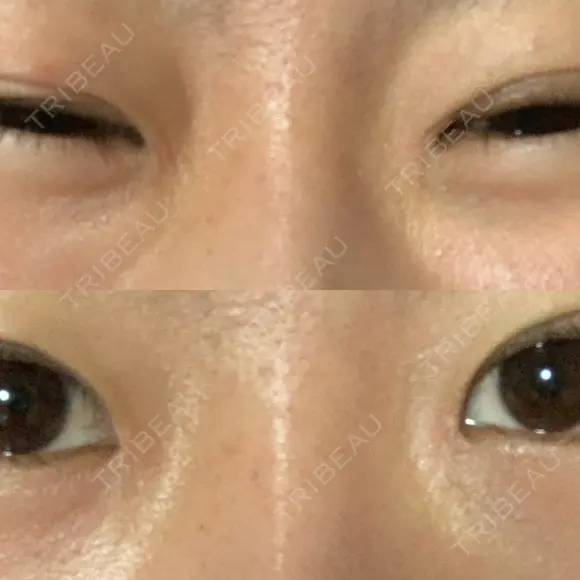 蒙古ひだ形成 R.O.clinic DAY 60 メイン用