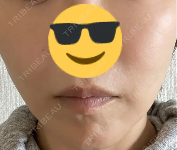 シミ取りレーザー / YAGレーザー PICO BEAUTY CLINIC DAY 8 メイン用