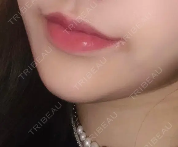 口唇縮小術 / 口角挙上 B-LINE CLINIC 池袋院 DAY 40 メイン用