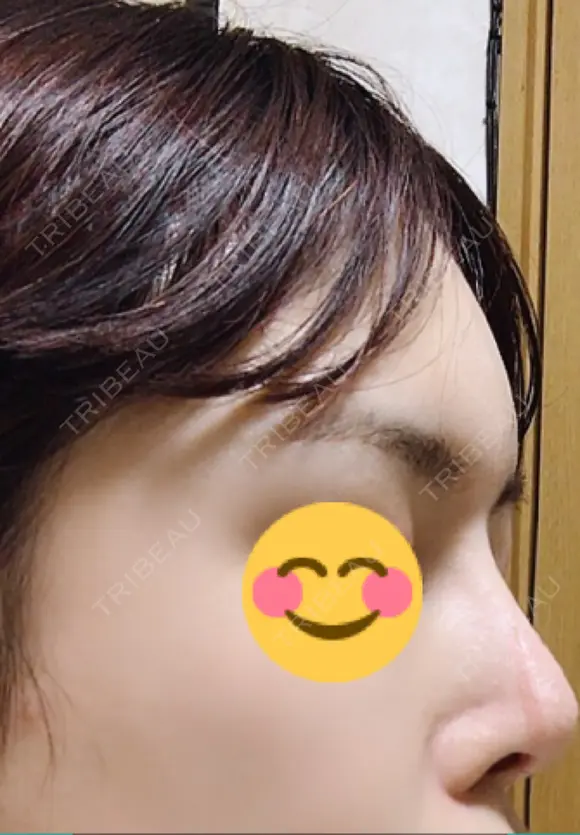 額を丸く / その他（輪郭） 品川美容外科 静岡院 DAY 72 メイン用