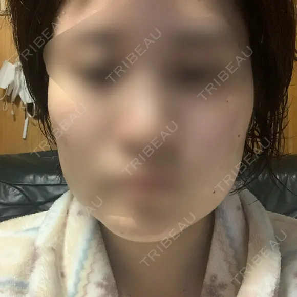 ボトックス（エラ・小顔） 湘南美容クリニック 名古屋院 DAY 9 メイン用