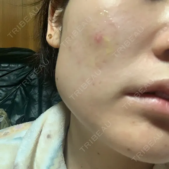 ボトックス（エラ・小顔） 湘南美容クリニック 名古屋院 DAY 10 メイン用