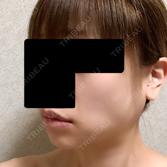 バッカルファット除去 / ボトックス（エラ・小顔） 湘南美容クリニック 金山院 DAY 6 メイン用