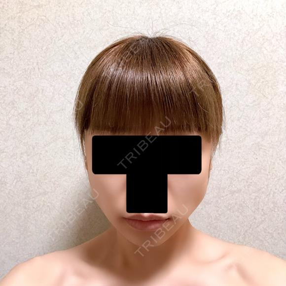 バッカルファット除去 / ボトックス（エラ・小顔） 湘南美容クリニック 金山院 AFTER メイン用