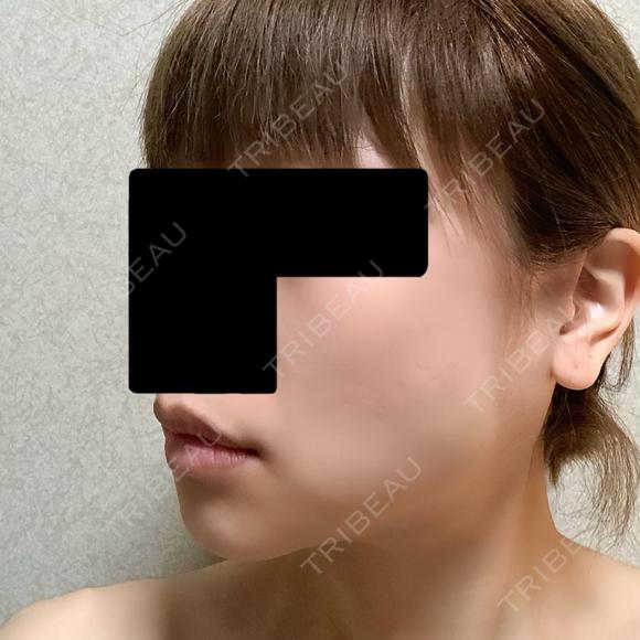 バッカルファット除去 / ボトックス（エラ・小顔） 湘南美容クリニック 金山院 DAY 5 メイン用