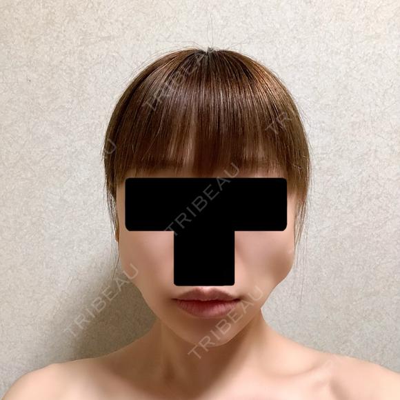バッカルファット除去 / ボトックス（エラ・小顔） 湘南美容クリニック 金山院 DAY 6 メイン用