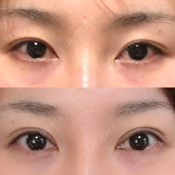 二重切開 / 眼瞼下垂（切開） / 上まぶたたるみ取り 湘南美容クリニック 新宿南口院 DAY 193 メイン用