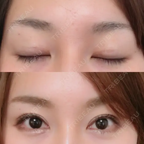 二重切開 / 眼瞼下垂（切開） / 上まぶたたるみ取り 湘南美容クリニック 新宿南口院 DAY 193 メイン用