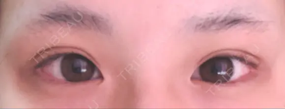 二重埋没 湘南美容クリニック 那覇院 DAY 5 メイン用