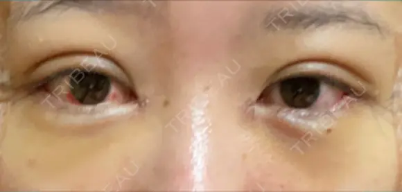 二重埋没 / 目頭切開 / 目尻切開 / タレ目形成・グラマラスライン（切開） HAAB×DREAM BEAUTY CLINIC 東京本院 DAY 4 メイン用