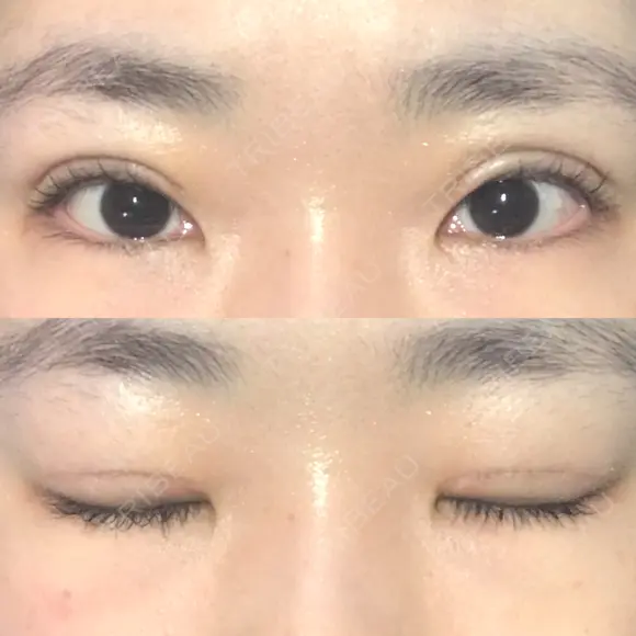 二重切開 / 上まぶたの脂肪取り 松下皮フ形成外科 DAY 14 メイン用